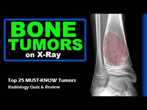 Видео: Опухоли костей, которые вы ОБЯЗАТЕЛЬНО должны знать на рентгенограмме | Топ-25 обзоров рентгеноло...