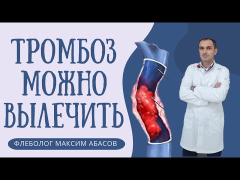 Видео: Тромб улетел. Мужчина выжил! Флеболог Москва.