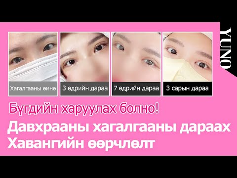 Видео: Давхрааны хагалгааны дараах хавдартаа санаа зовж байна уу? Юүну шийдэж өгнө!