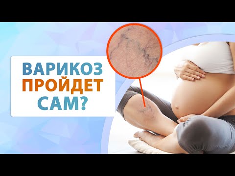 Видео: Варикоз у беременных флеболог Москва