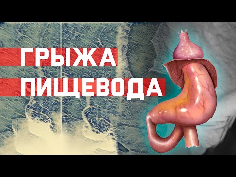Видео: Грыжа пищеводного отверстия. Какие упражнения могут помочь?
