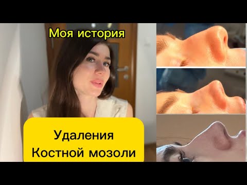 Видео: Горбинка на носу снова после ринопластики