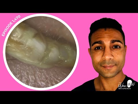 Видео: 1470 - Из уха удалена эпидермальная пробка в виде гусеницы, кюретка Rai, натуральные увлажняющие ...