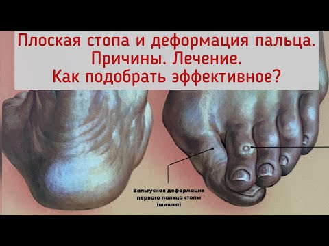 Видео: Поперечное плоскостопие, косточка на стопе. Причины. Как самому выбрать подходящее лечение.