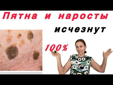 Видео: 🟡🔵 Избавиться навсегда 100%…. от старческих пятен и наростов ( часть - 1 )