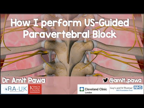 Видео: Как я провожу паравертебральные блокады под контролем УЗИ