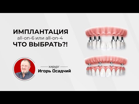 Видео: Имплантация Все-на-4 и Все-на-6, что выбрать?