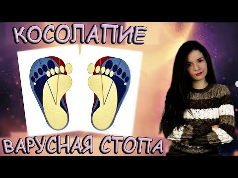 Видео: Косолапие / Варусная стопа