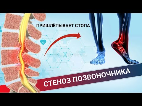 Видео: НЕ СЛУШАЕТСЯ СТОПА И ПРИШЛЕПЫВАЕТ || ПРИЧИНА - СТЕНОЗ