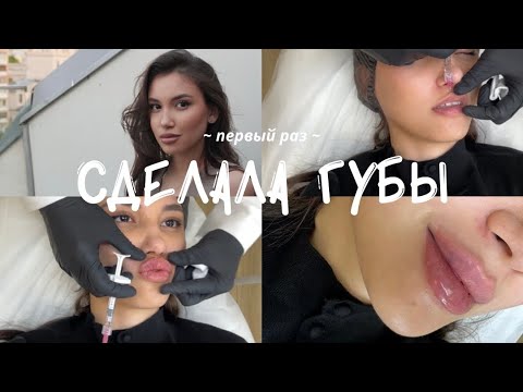 Видео: УВЕЛИЧИЛА ГУБЫ | реакция родителей, процесс заживления, осуждала, но решилась, выбор косметолога