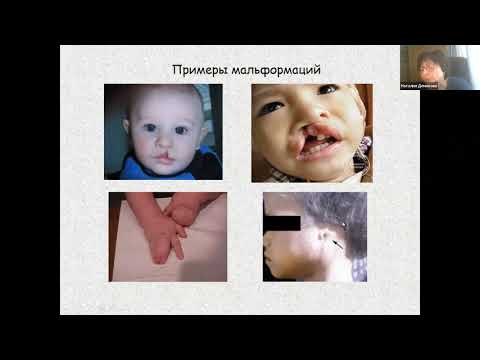 Видео: Врожденные пороки развития: классификация, этиология, профилактика. Демикова Н.С.