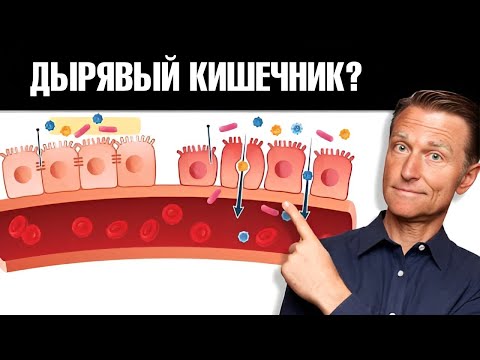 Видео: 7 признаков синдрома дырявого кишечника. Воспаление кишечника🧐