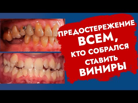 Видео: Виниры. Ошибки пациентов, которые приведут к проблемам!