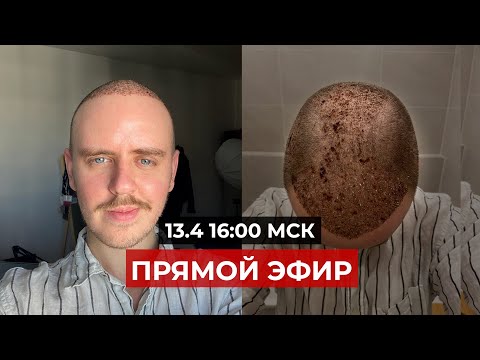 Видео: Прошла неделя с пересадки волос, отвечаю на вопросы