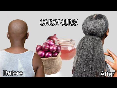 Видео: СРЕДСТВО НА ОСНОВЕ ЛУКОВОГО СОКА ДЛЯ БЫСТРОГО РОСТА ВОЛОС/ЛУКОВЫЙ СОК ДЛЯ РОСТА ВОЛОС