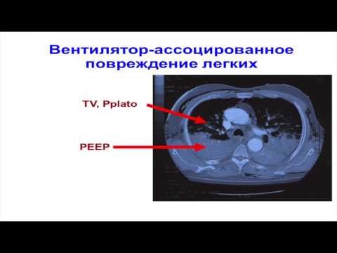 Видео: Современное представление об ARDS А.А.Полупан