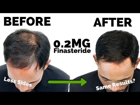 Видео: ПРОРЫВ в области микродозирования финастерида: 0,2 мг — новая дозировка?