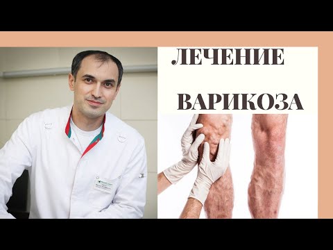 Видео: Лечение варикоза. Флеболог Москва.