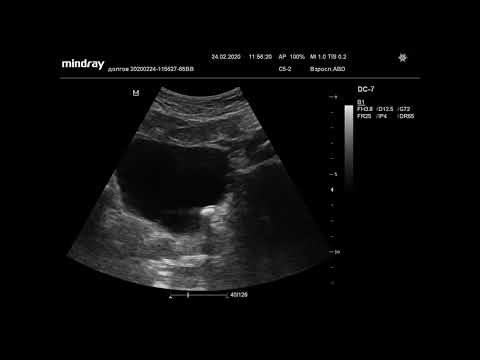 Видео: Ультразвуковая диагностика. Доктор Иогансен. Видеопримеры. Выпуск 3. Камень в устье мочеточника.