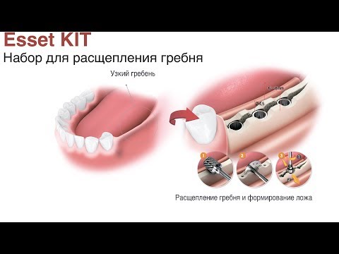 Видео: Esset KIT. Набор для расщепления гребня