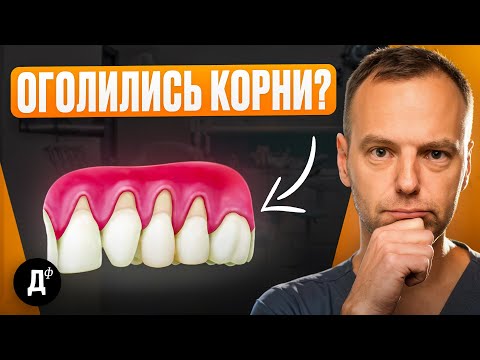 Видео: Десна “УШЛА” от зуба? Что делать, чтобы НЕ ПОТЕРЯТЬ зуб? Посмотри, если у тебя проблемы с дёснами!