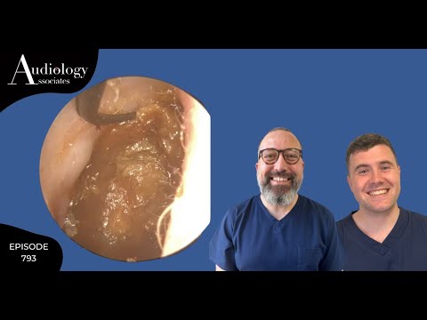 Видео: ОЧЕНЬ СЛОЖНОЕ УДАЛЕНИЕ УШНОЙ СЕРЫ - EP793