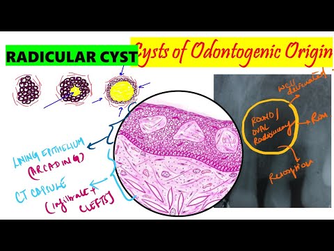 Видео: Радикулярная киста | Периапикальная киста | ГИСТОПАТОЛОГИЯ | Клинические особенности | Этиопатогенез