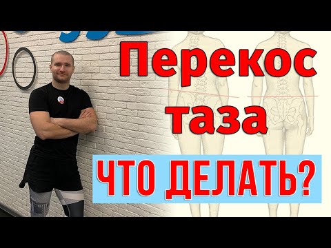 Видео: Перекос таза. Сколиоз. Как исправить и что делать?