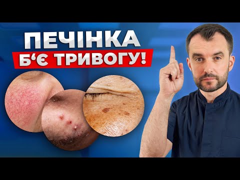 Видео: Перші ознаки проблем з печінкою! НЕ ІГНОРУЙ ЦІ СИГНАЛИ!