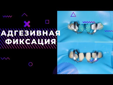 Видео: АДГЕЗИВНАЯ ФИКСАЦИЯ КЕРАМИКИ