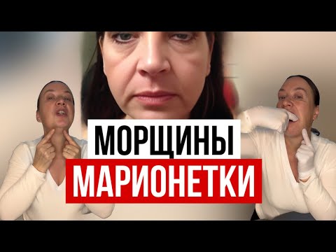 Видео: Убираем морщины марионетки. Быстро! 
