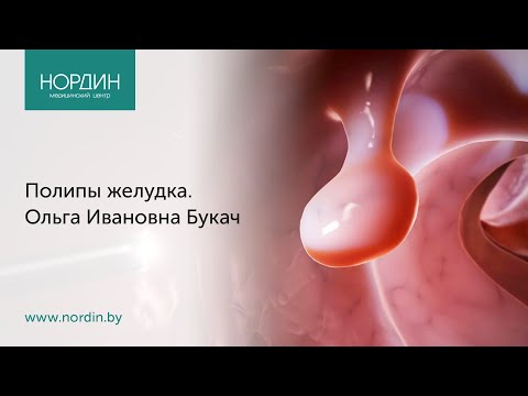 Видео: Полипы желудка, врач Ольга Букач