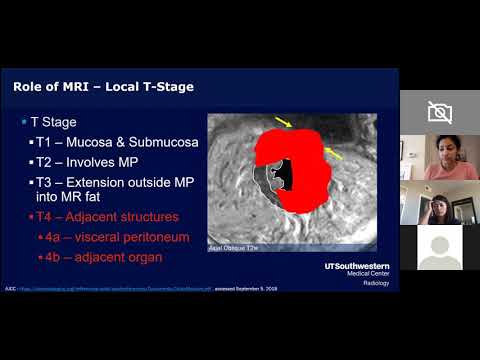 Видео: Стадирование рака прямой кишки по данным МРТ — всё, что вам нужно знать! Доктор Гаурав Кхатри