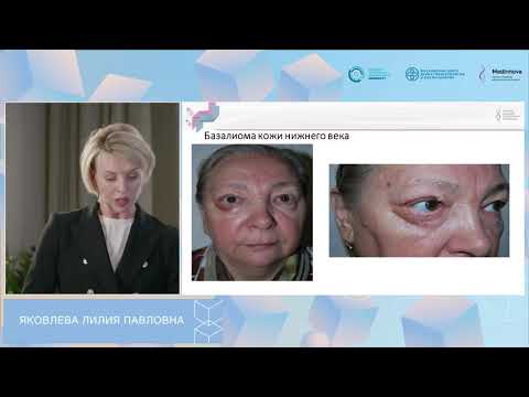 Видео: Яковлева Л.П. Хирургические аспекты лечения ЗНО кожи лица