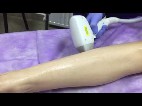 Видео: Лазерная эпиляция в Минске