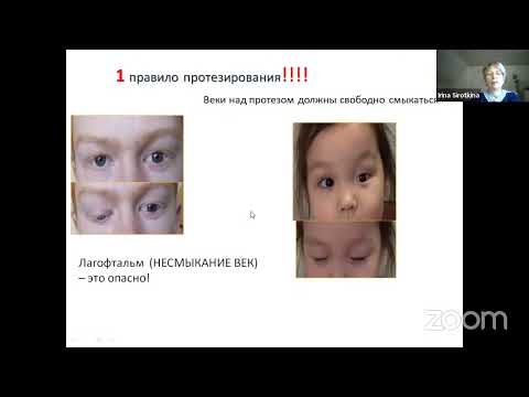 Видео: 5. Как использовать глазной протез, чтобы жизнь была комфортной? ГП 2023