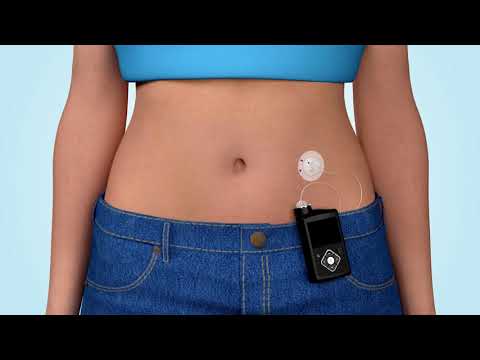 Видео: Что такое инсулиновая помпа?
