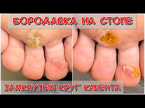 Видео: Бородавка на подошве стопы / Бородавки на ноге что делать / Бородавки на ноге