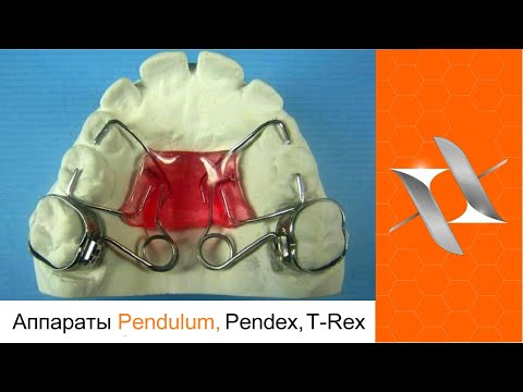 Видео: Ортодонтический аппарат Пендулум. Оrthodontic appliance Pendulum, Pendex, T - Rex, MDA.