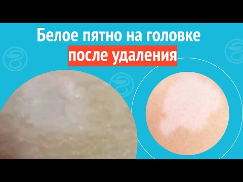 Видео: 😕 Белое пятно на головке после удаления. Клинический случай №1692
