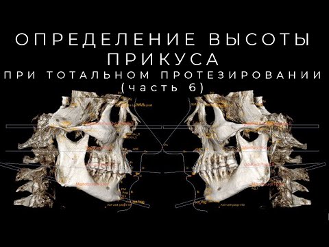Видео: Оределение Высоты Прикуса (часть 6)