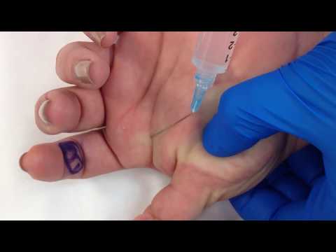 Видео: Блокады нервов запястья и кисти