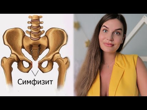 Видео: 2 РОДОВ с СИМФИЗИТОМ // МОЙ ОПЫТ // 12 мм расхождение