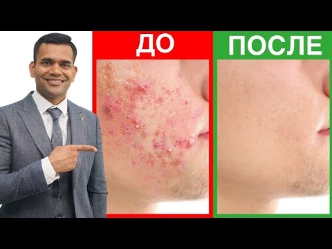 Видео: Быстро Избавьтесь От Прыщей / Угрей. Не Совершайте Этих Ошибок!