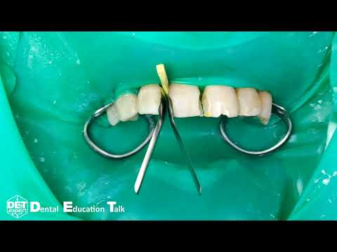 Видео: Изоляция во фронтальной группе зубов В.Ч. межзубные матрицы, фиксация DET.expert 4K