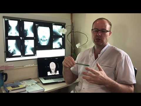 Видео: Симптомы смещения Атланта. Рентген диагностика шеи