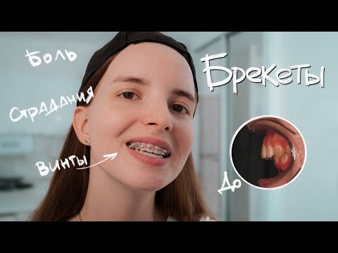 Видео: Всё, что нужно знать о БРЕКЕТАХ. Страдания, которые меняют жизнь к лучшему | Моя история.