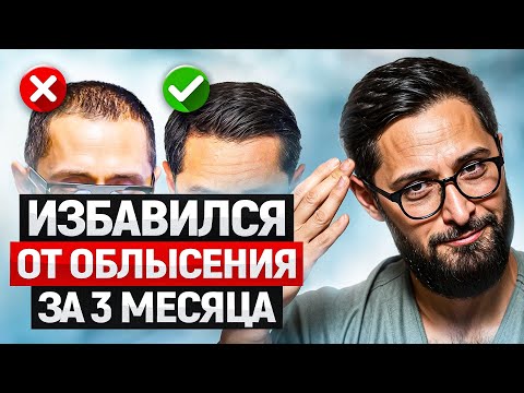 Видео: Мужское облысение - не приговор! Моя история избавления от залысин без пересадок