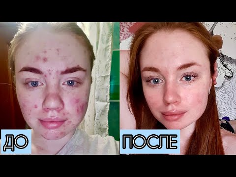 Видео: Сотрет / Ретиноиды / Лечение акне до после