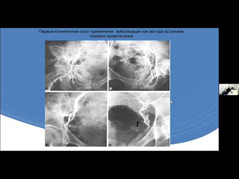Видео: Шевакин А.Г., Капто А.А., Шкабурин А.Д. Эндоваскулярное лечение гиперплазии предстательной железы.
